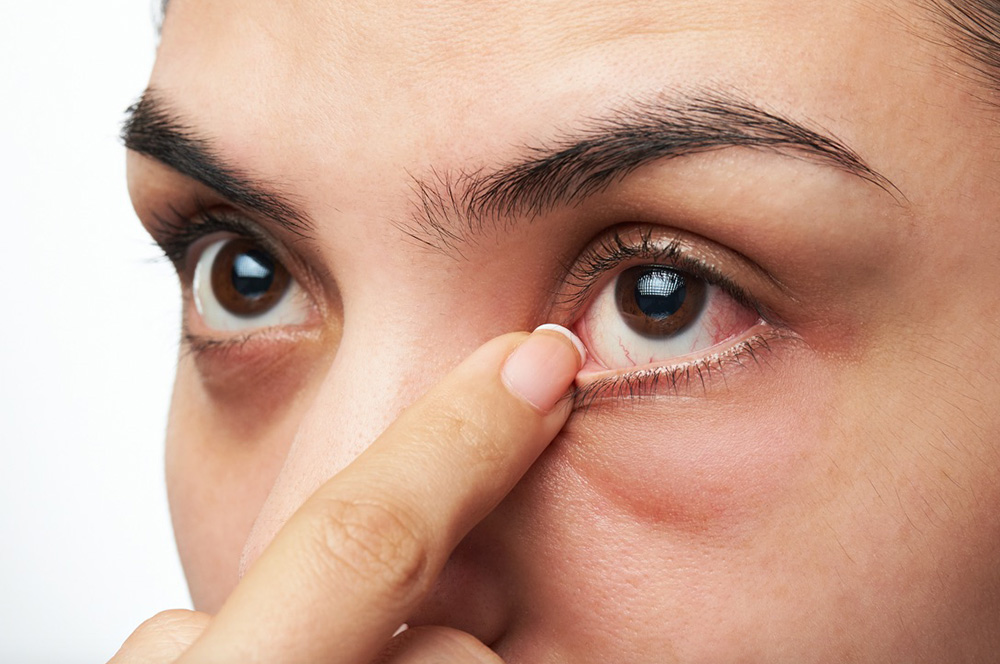 ۶ راهکار برای جلوگیری از خشکی چشم پس از بلفاروپلاستی