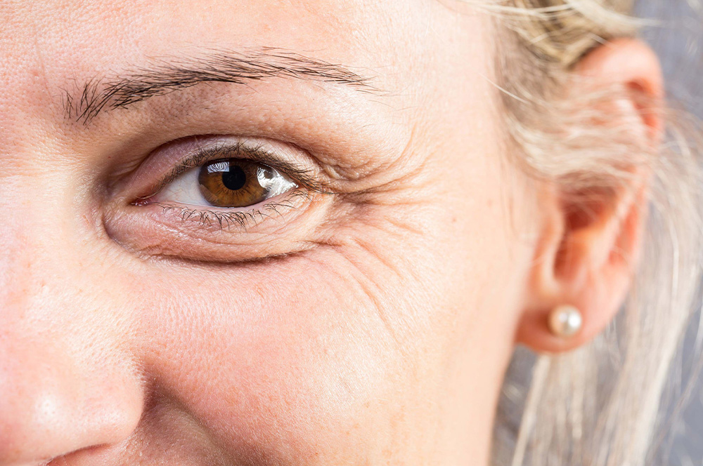آیا پوست اضافی چشم بعد از بلفاروپلاستی دوباره رشد می‌کند؟