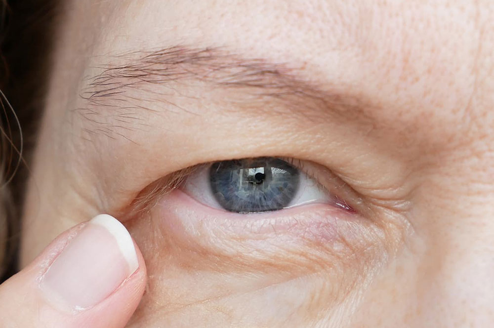 آیا بینایی بعد از بلفاروپلاستی تغییر می‌کند؟