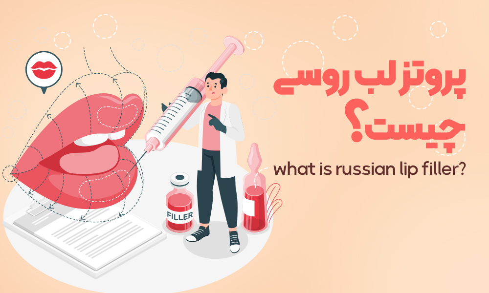 فیلر لب روسی چیست؟