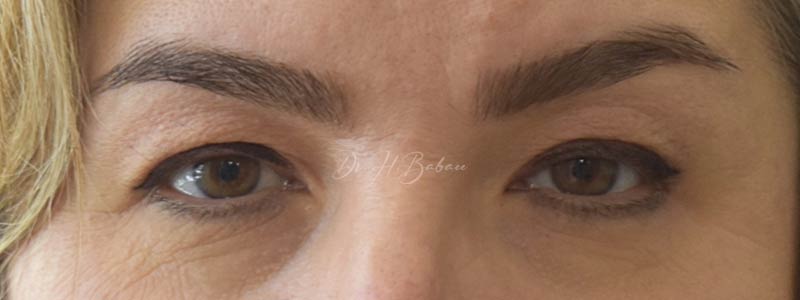 قبل و بعد از بلفاروپلاستی 1403