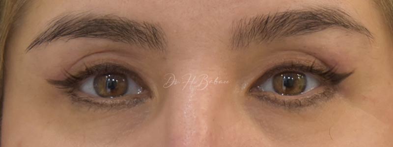 قبل و بعد از بلفاروپلاستی 1403