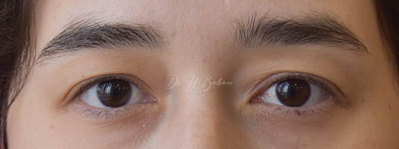 قبل و بعد از بلفاروپلاستی 1403