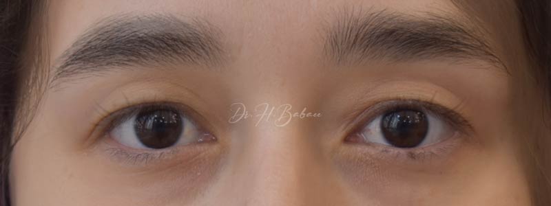 قبل و بعد از بلفاروپلاستی